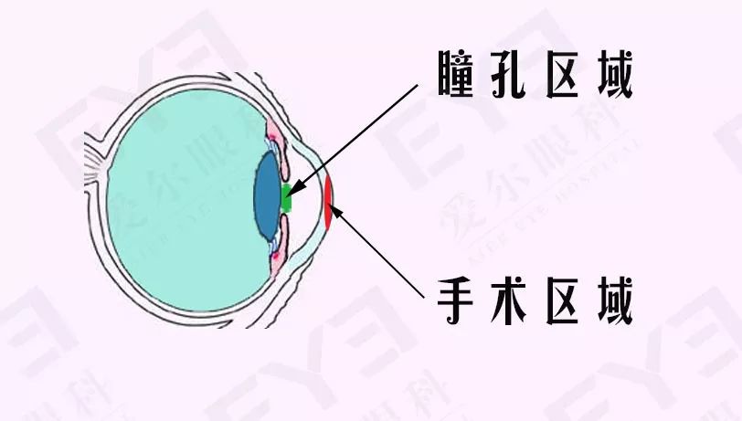 近视手术原理