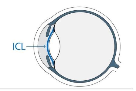 ICL晶体植入术有后遗症