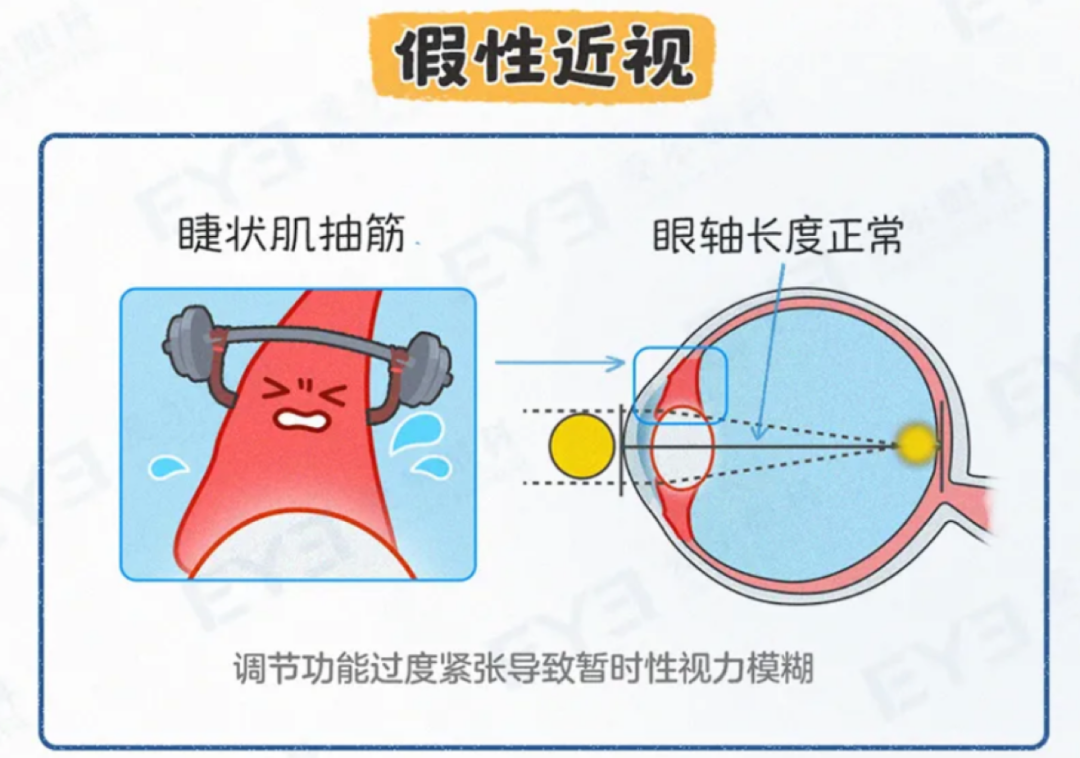 假性近视.png