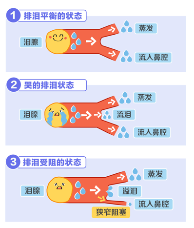 泪道2.png